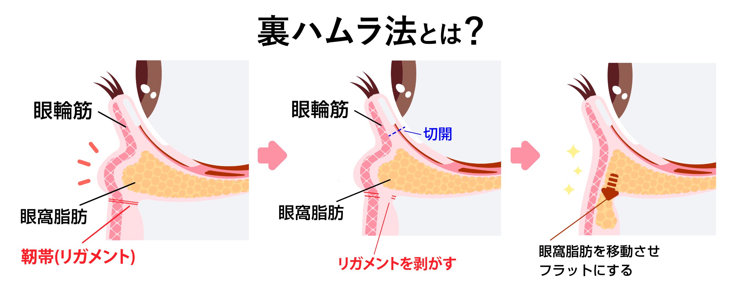 裏ハムラ法とは？｜自身の脂肪を再配置する究極の根本治療