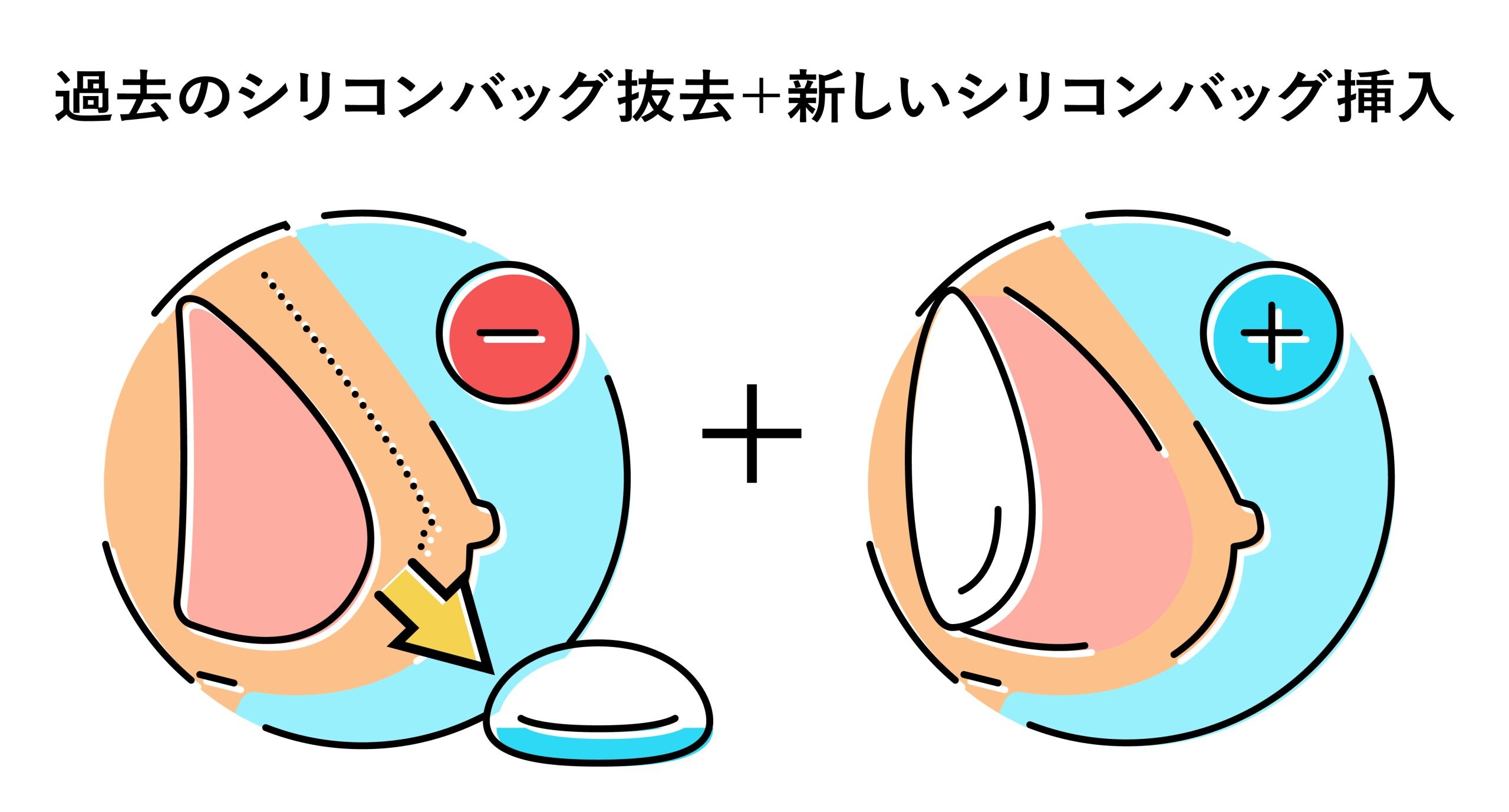 ①バッグのサイズ変更・入れ替え<br />
