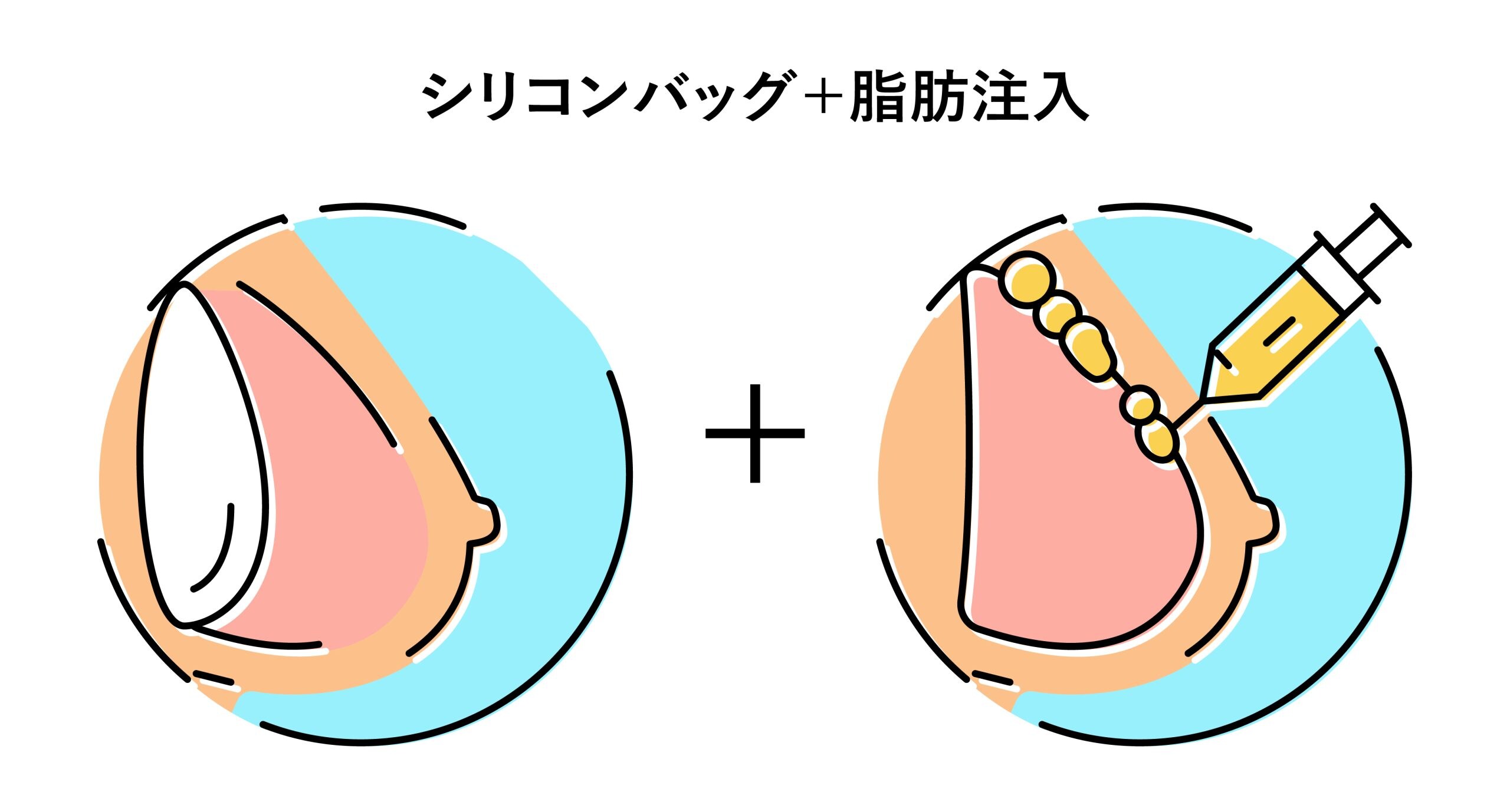 ③ハイブリッド豊胸<br />

