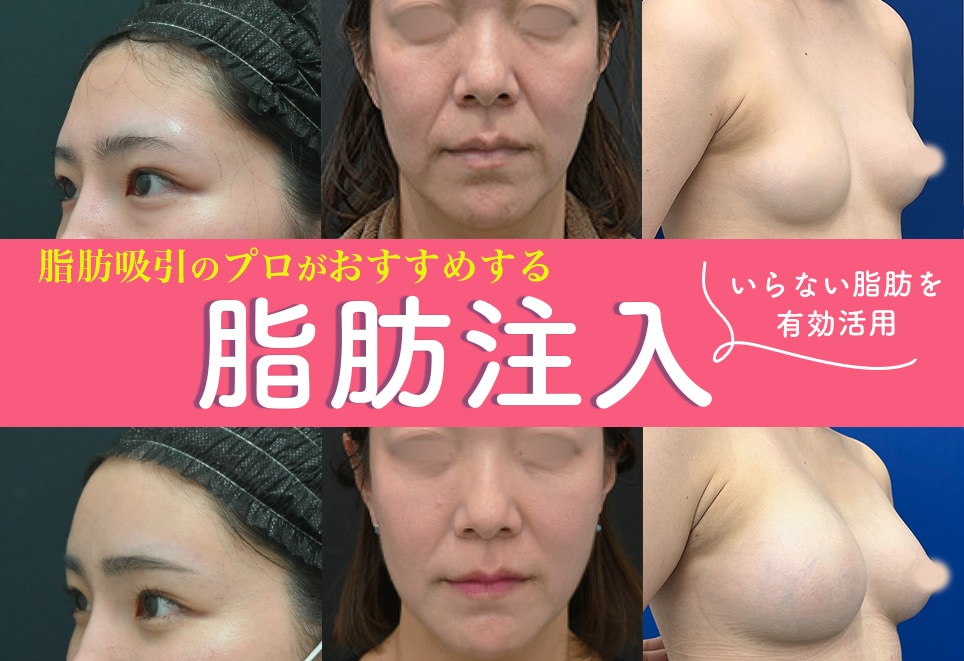 名古屋で脂肪注入するなら【脂肪のプロ】脂肪吸引の名医山本高士医師がおすすめ！