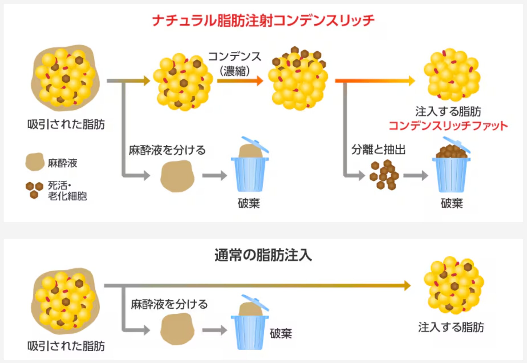 ナチュラル脂肪注射コンデンスリッチ（脂肪注入）とは？