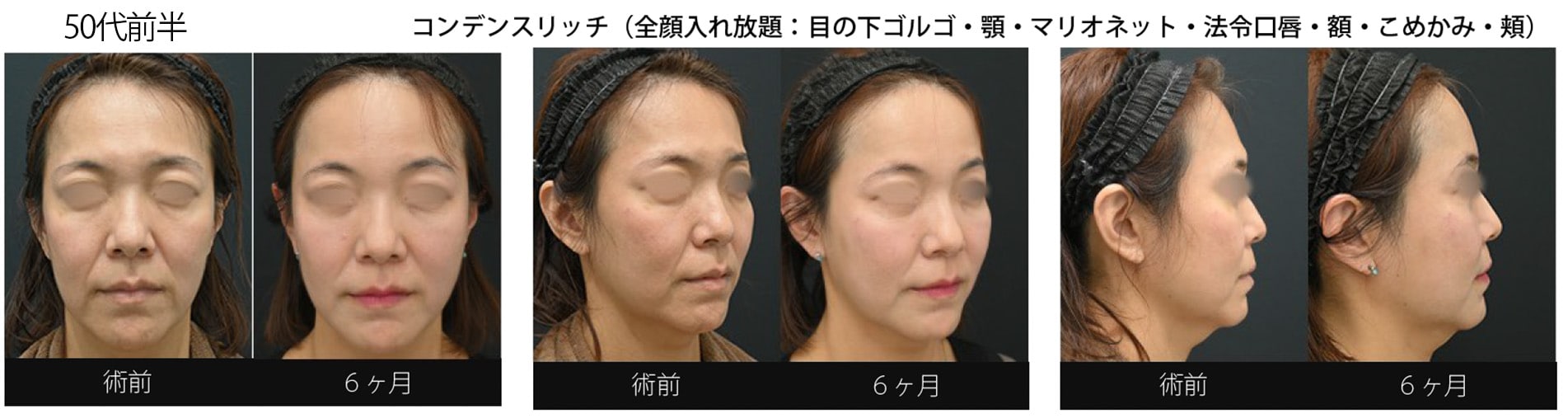 顔の脂肪注入し放題！