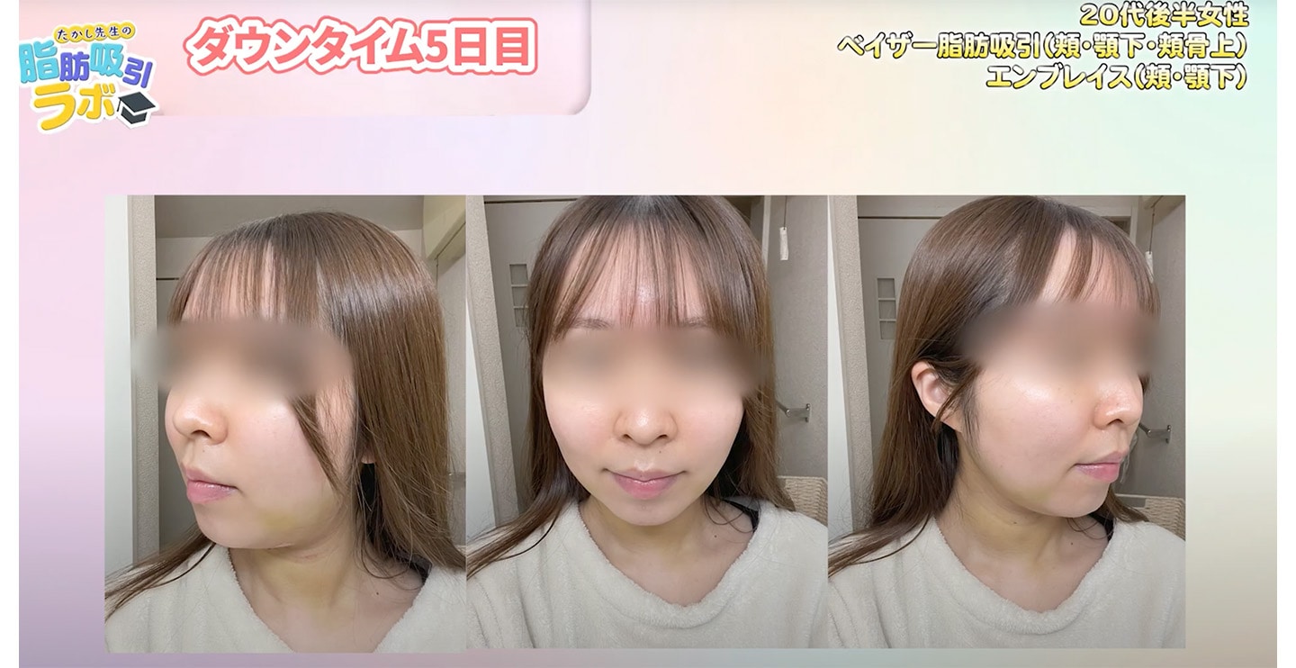 【ダウンタイム5日目】