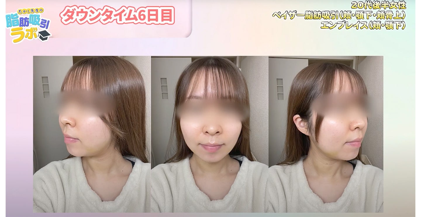 【ダウンタイム６日目】