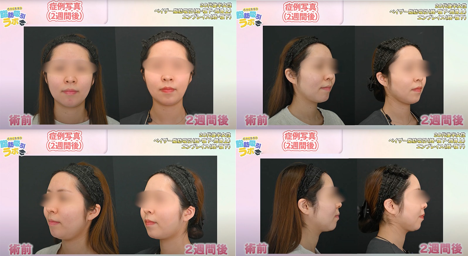症例写真【術前▶︎２週間】