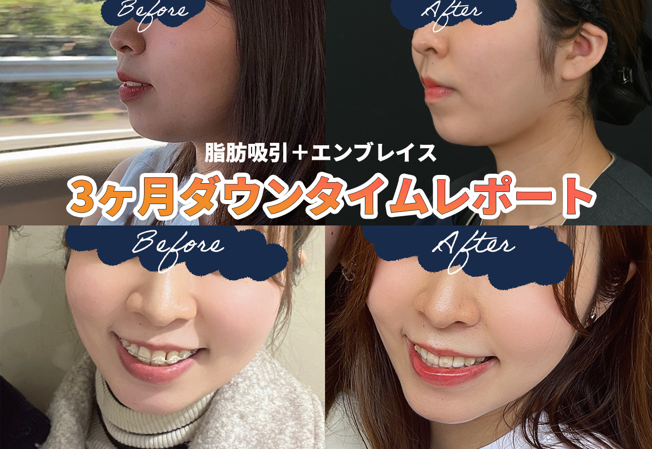 顔の脂肪吸引とエンブレイスのダウンタイムについて。脂肪吸引するなら“脂肪吸引の名医”山本高士先生にお任せ! 【湘南美容クリニック 名古屋院】