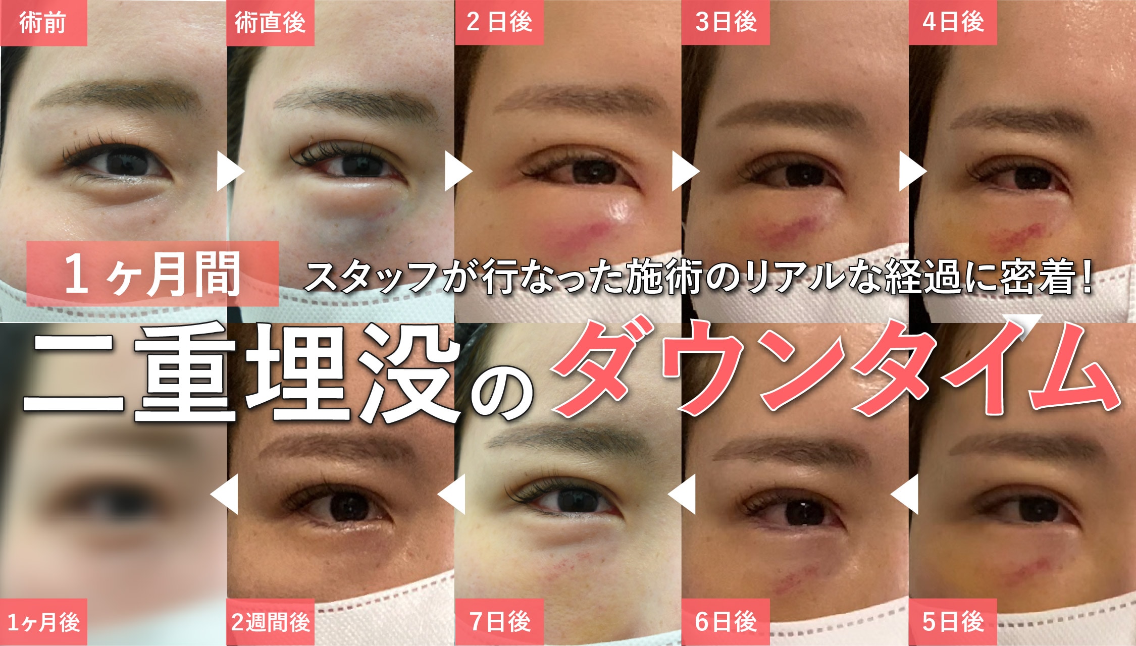 【写真で見る】二重埋没法ダウンタイムのリアルな経過。施術から仕事復帰まで徹底解説！｜名古屋院 山本医師監修