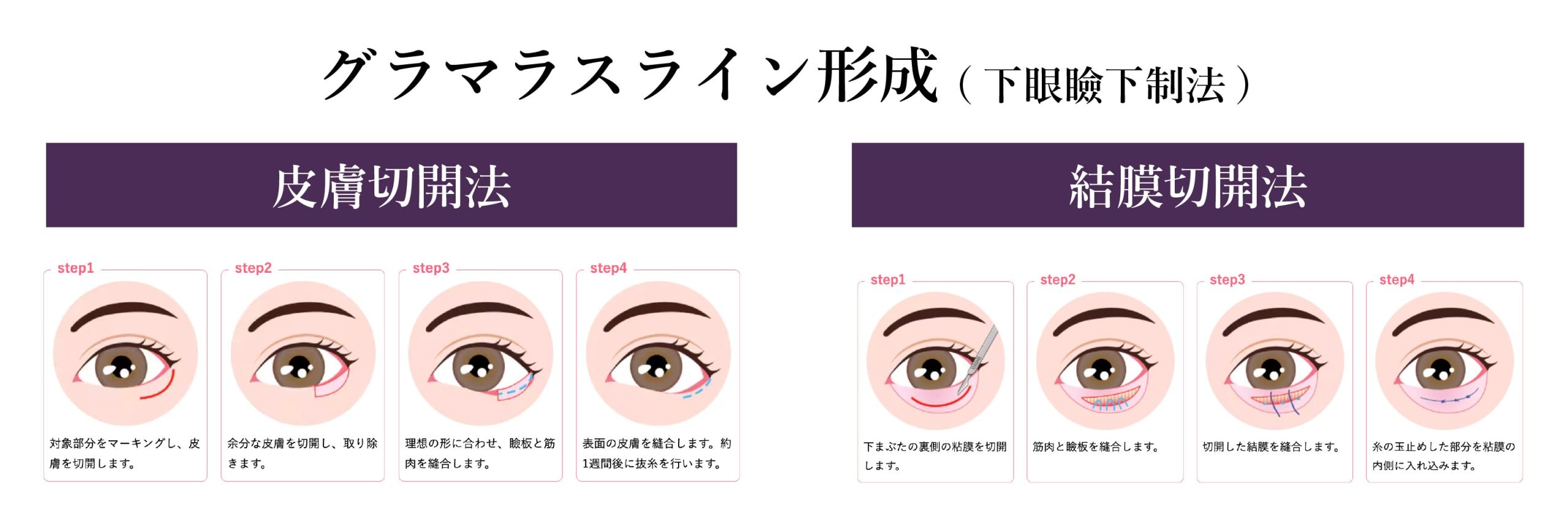 タレ目形成（下眼瞼下制法）