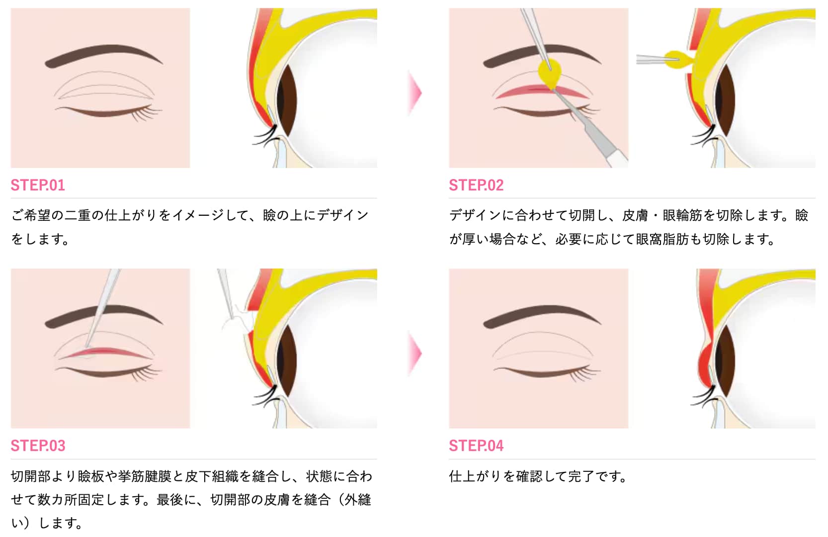 全切開二重術