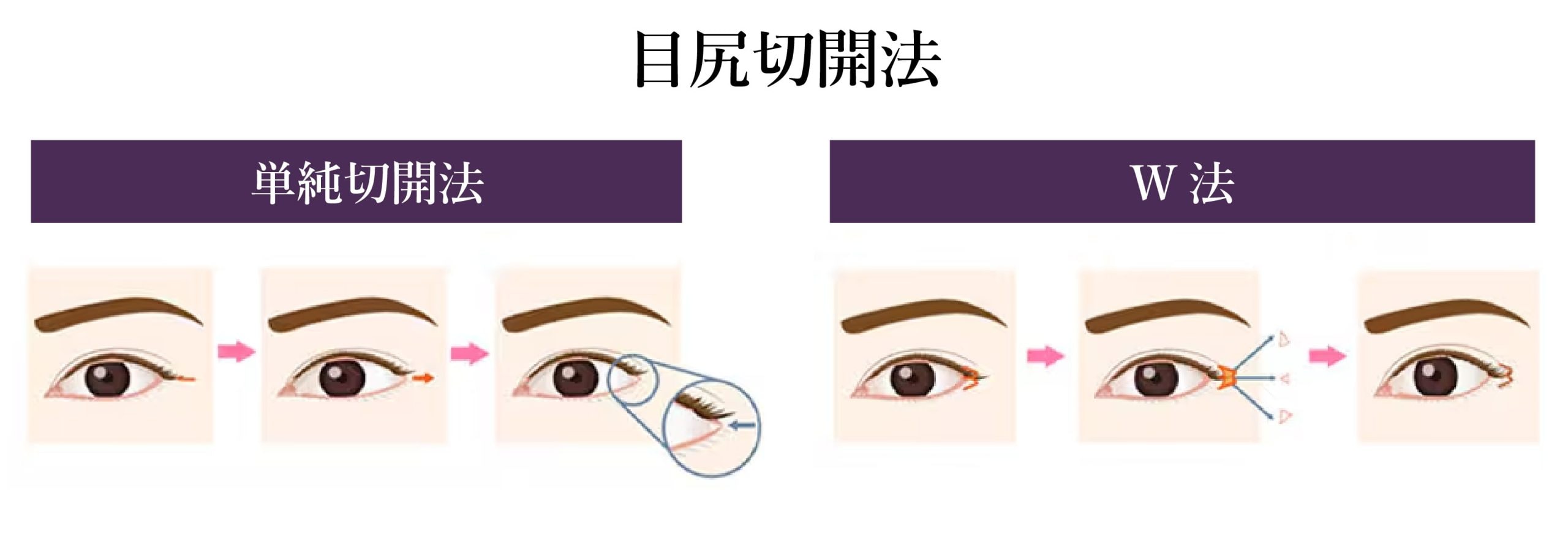 目尻切開