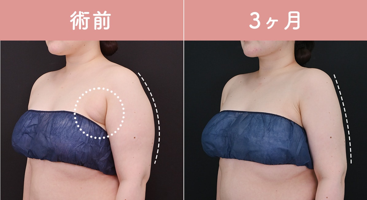 　　　　20代後半　160cm 75.9kg BMI29.6 <br />
アキーセル脂肪吸引（二の腕全周+肩+肩甲骨上＋背中＋脇肉＋副乳）