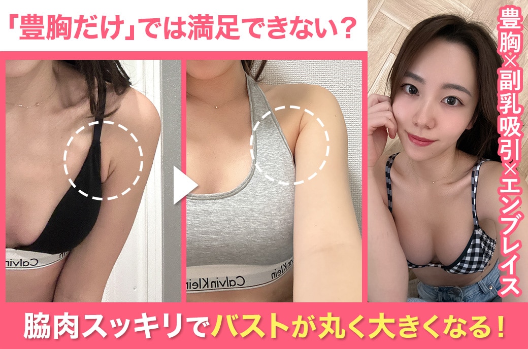 豊胸×副乳の脂肪吸引、エンブレイスRFでバストはもっと美しくなる。SBC名古屋院山本高士院長によるメリハリ豊胸術