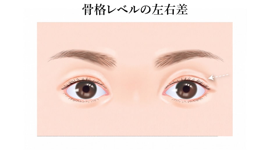 原因④：術前に知らされなかった「骨格レベルの左右差」