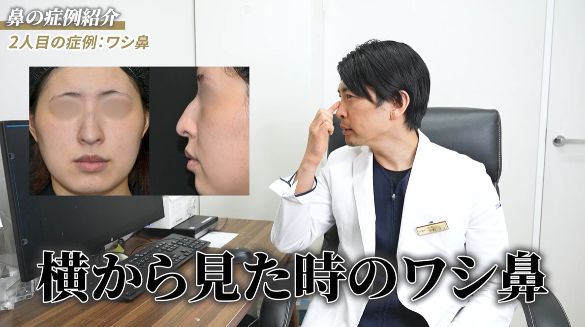 鷲鼻について解説