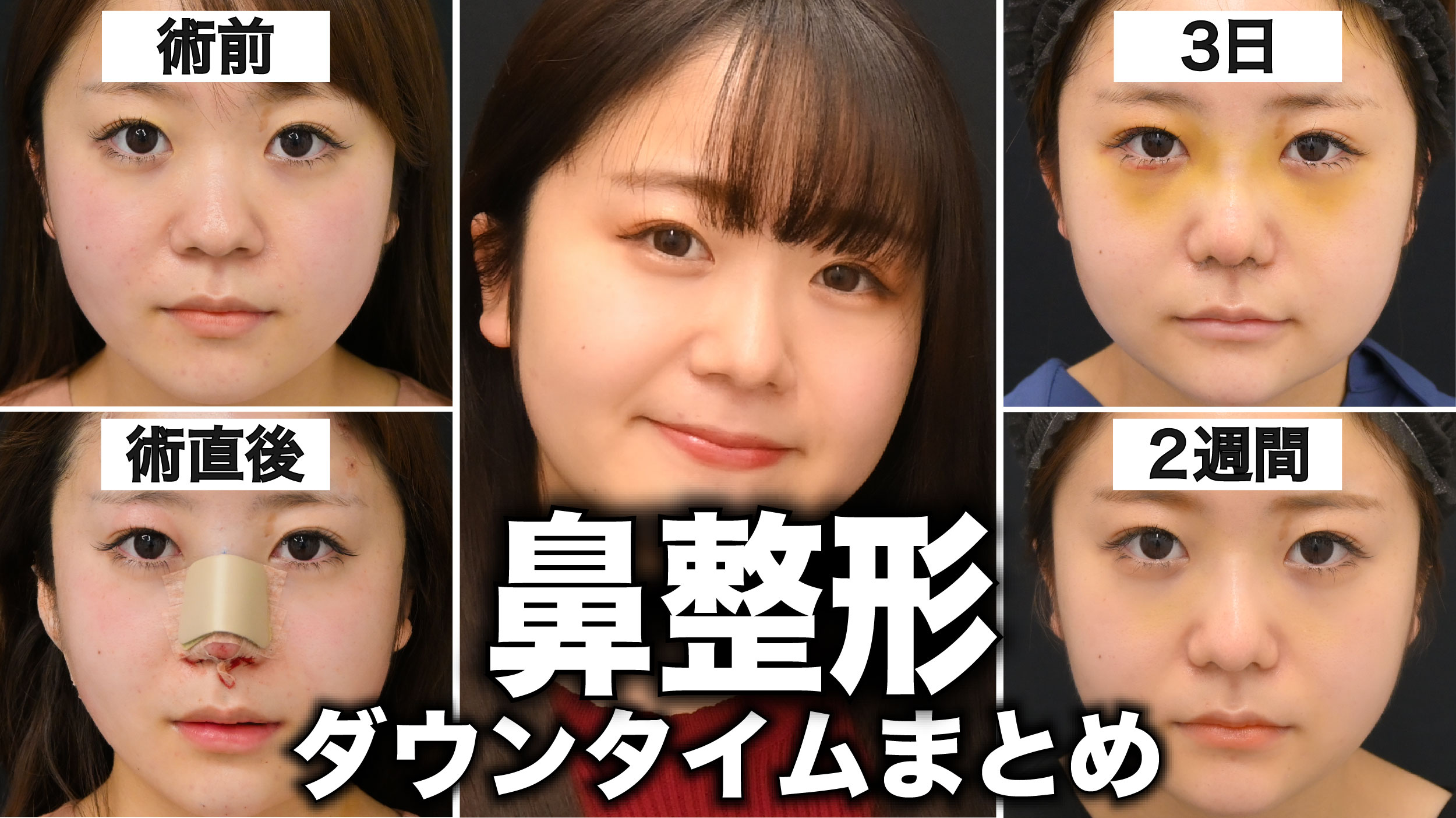 鼻整形のダウンタイムは？症状や過ごし方、仕事復帰のタイミングを症例を元に解説！