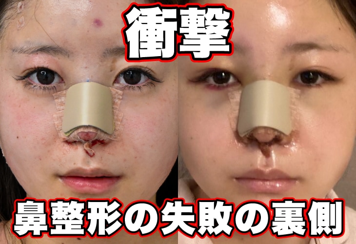 【鼻整形失敗!?】知らないと後悔する鼻整形の真実を解説!!失敗事例と原因を解説!!