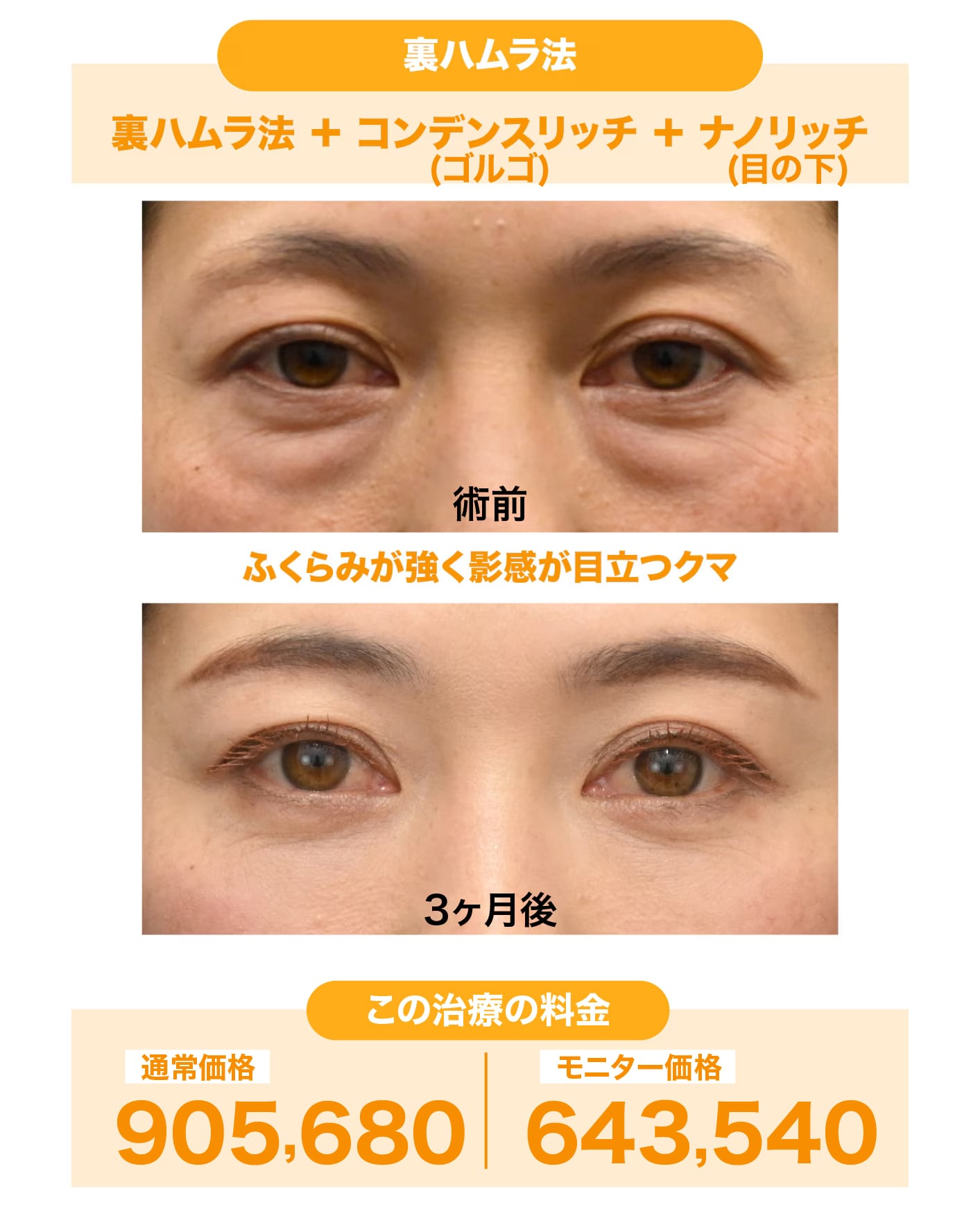 40代女性：裏ハムラ法＋ナチュラル脂肪注射（コンデンスリッチ・ナノリッチ）
