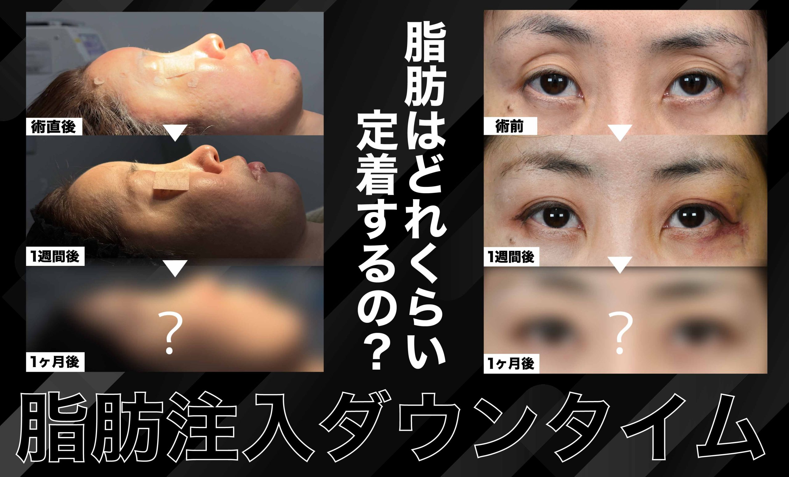 顔の脂肪注入のダウンタイムや脂肪はどれくらい定着するのか？脂肪注入で若返りは可能なのを徹底解説！