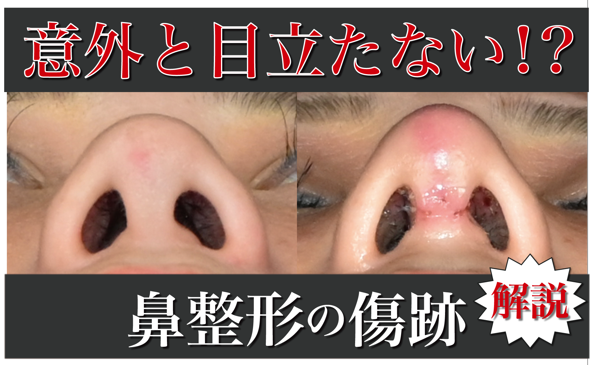 【鼻整形の傷跡】はどれくらい残る?実際の症例写真で比較!名古屋栄院の院長が解説します。