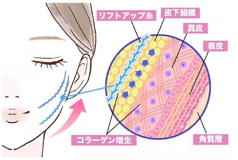 糸リフト