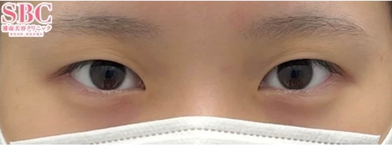 {施術名} {年代}  {性別} の術前の症例写真