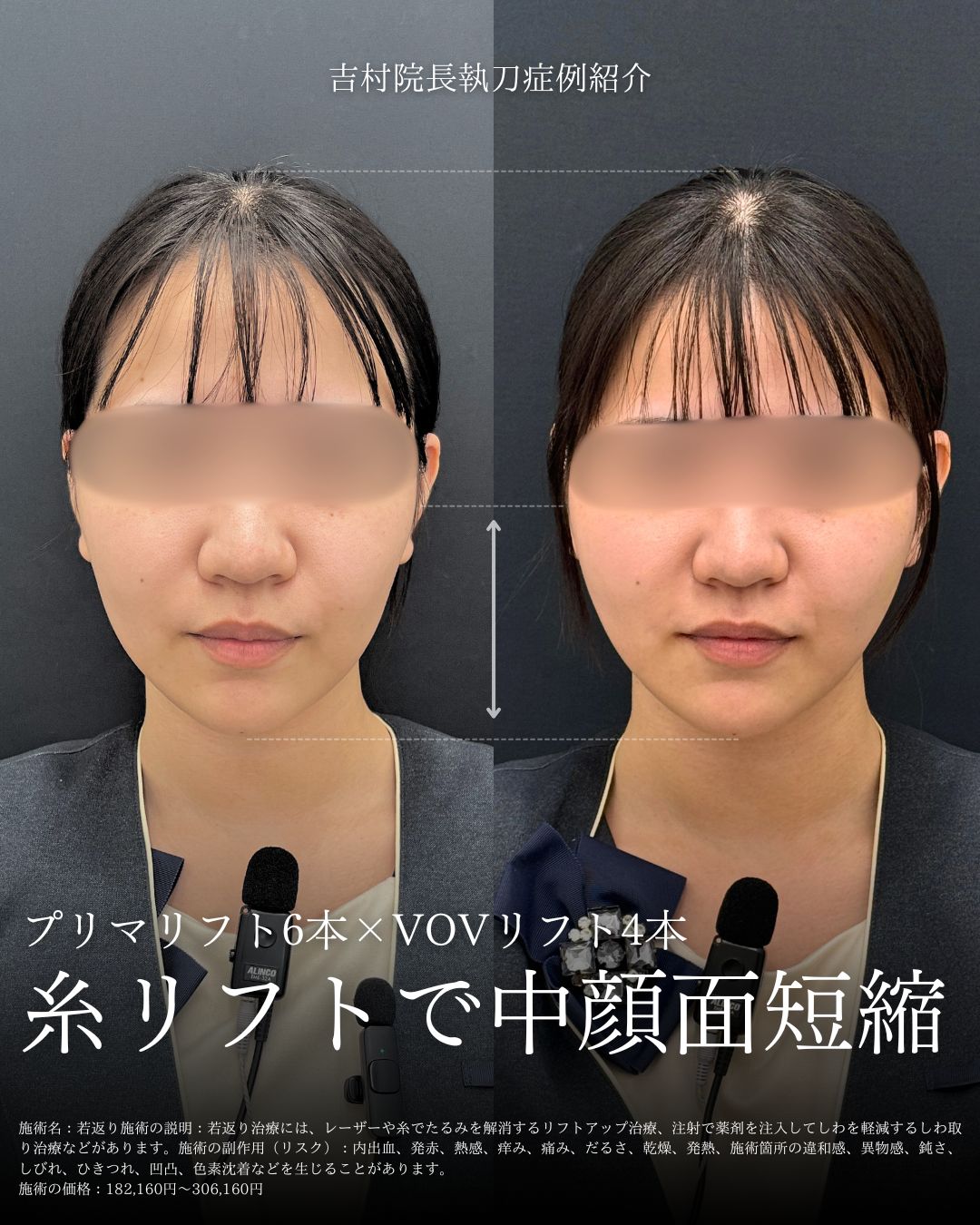 沖縄で小顔治療するなら湘南美容クリニック那覇院がおすすめな理由！