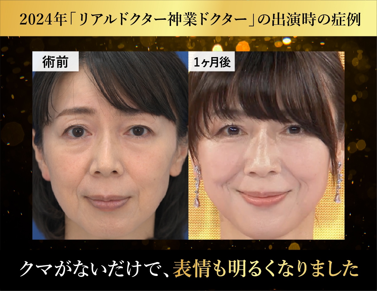 クマ取り症例：50代前半・女性