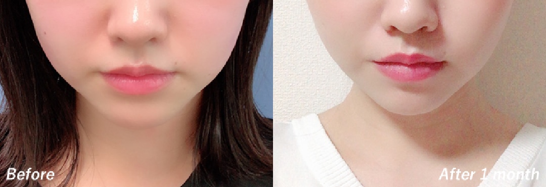 ＼医疗HIFU治疗同时让效果实现到最大限推荐的附加项目／<br />
【HIFU照射前】<br />
促进胶原蛋白，进一步提升紧致感