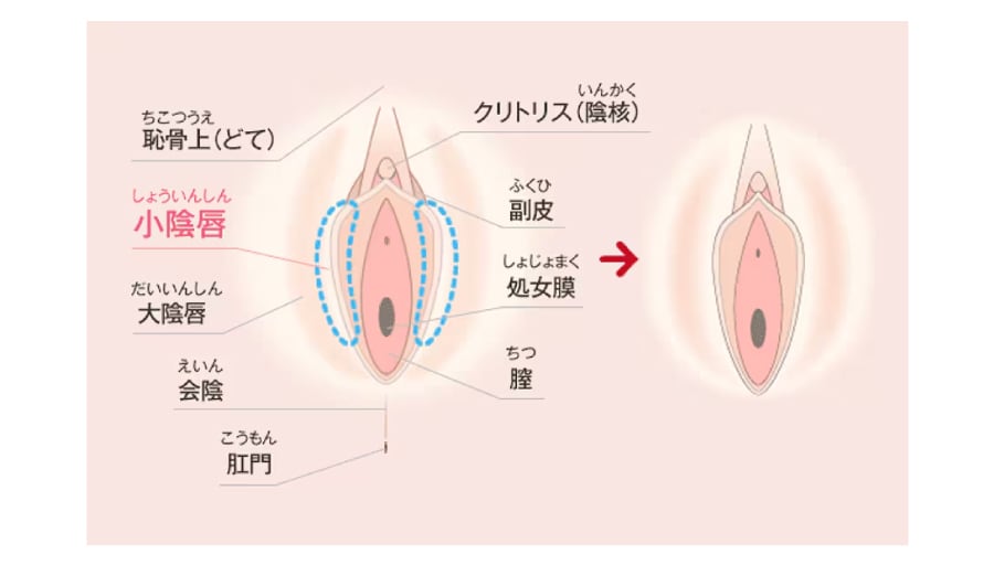 小陰唇縮小術