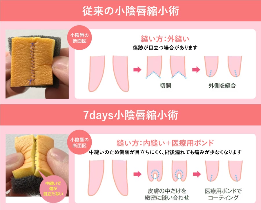 ダウンタイムを大幅軽減！抜糸不要の小陰唇縮小術とは？