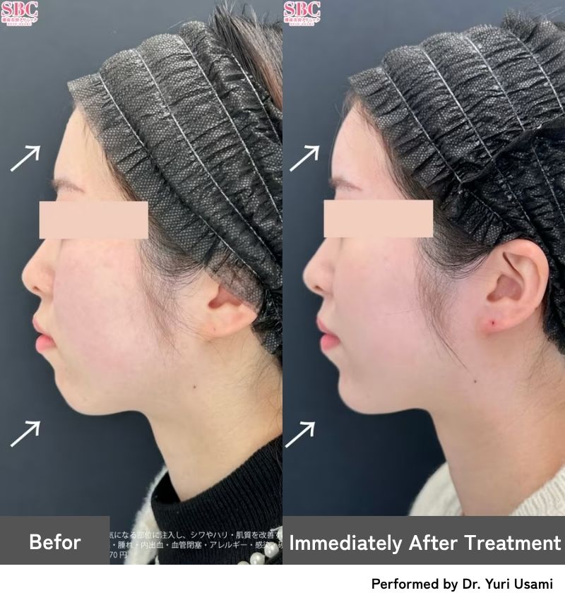 Forehead & Chin Contouring<br />
Get a Soft, Rounded Forehead and a Perfect E-Line!