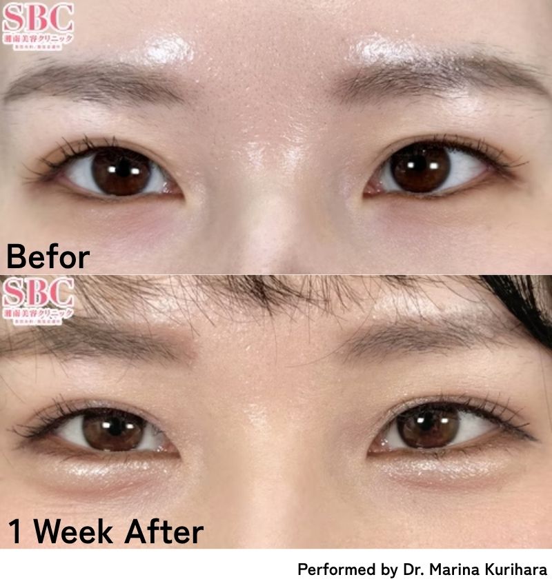 Under-Eye Aegyo-sal Enhancement<br />
⇨Get a Deeper, Dewy Look for Instantly Radiant Eyes!