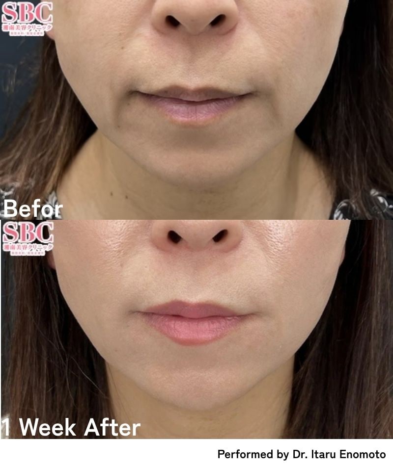 Nasolabial Folds & Marionette Lines <br />
⇨Smooth Away Deep Wrinkles for an Instantly Youthful Look!