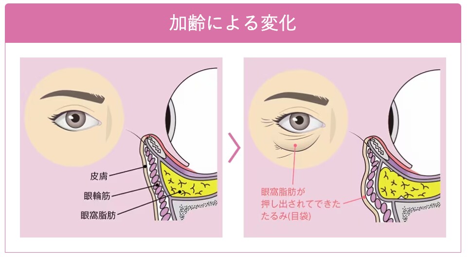 クマの原因は”眼窩脂肪”