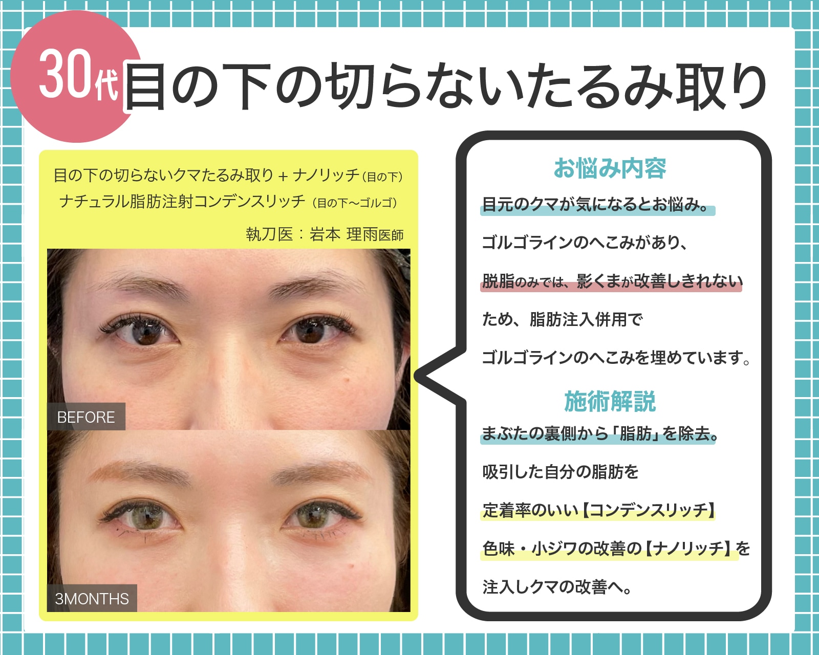 余分な【眼窩脂肪】を除去、膨らみ改善