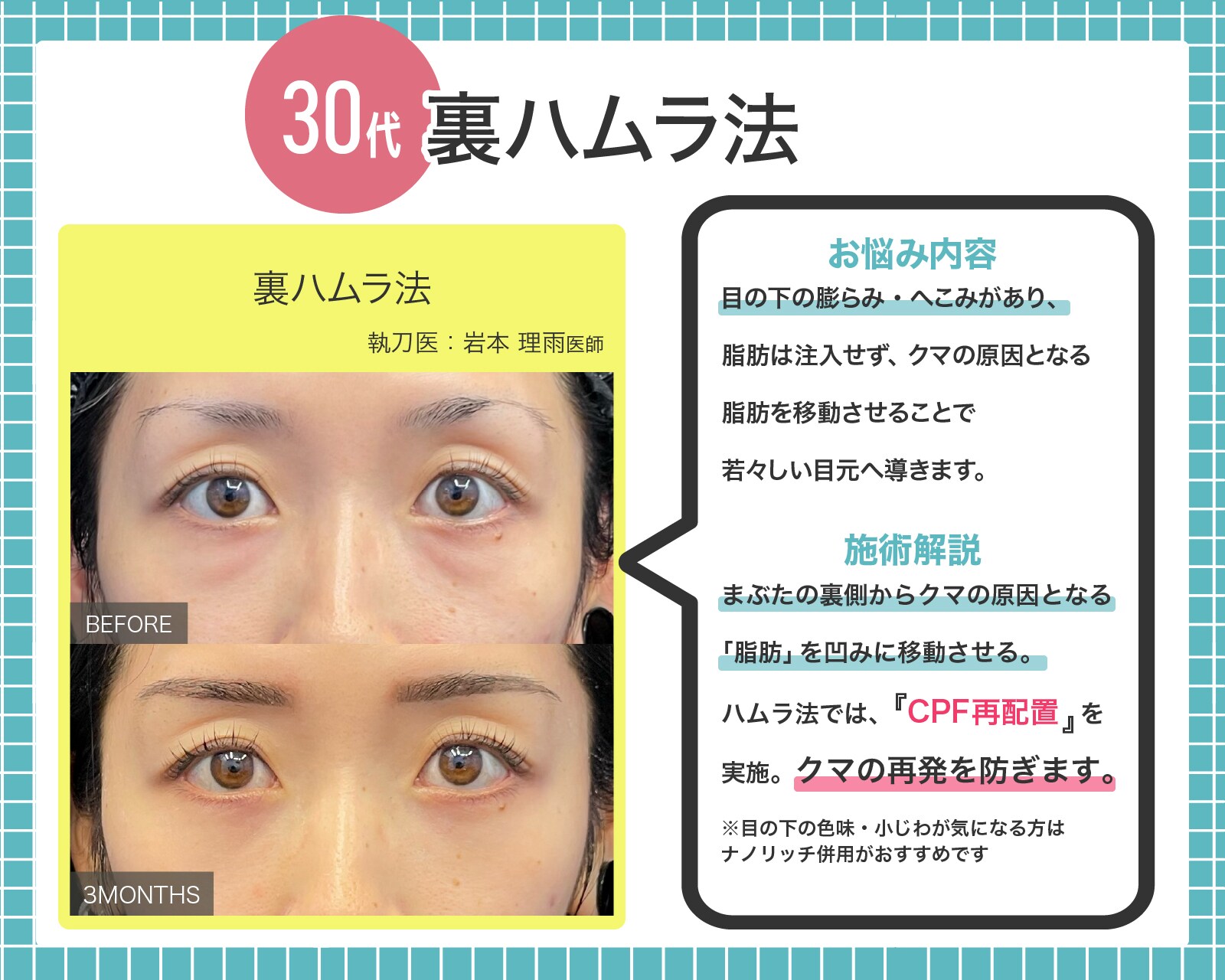 余分な【眼窩脂肪】を移動、くぼみも一緒に改善