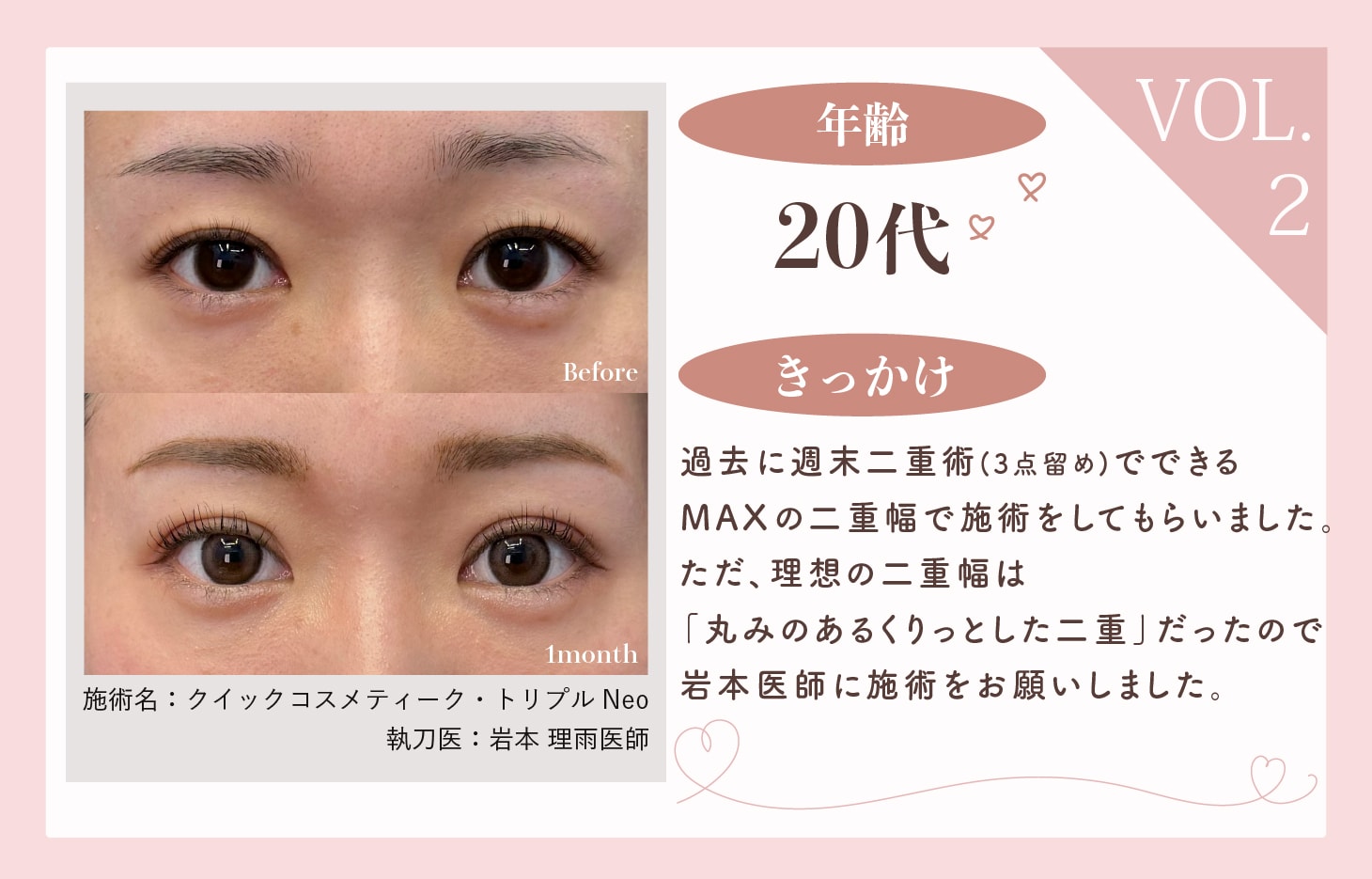 過去にした埋没法のラインより理想の二重幅にしたい