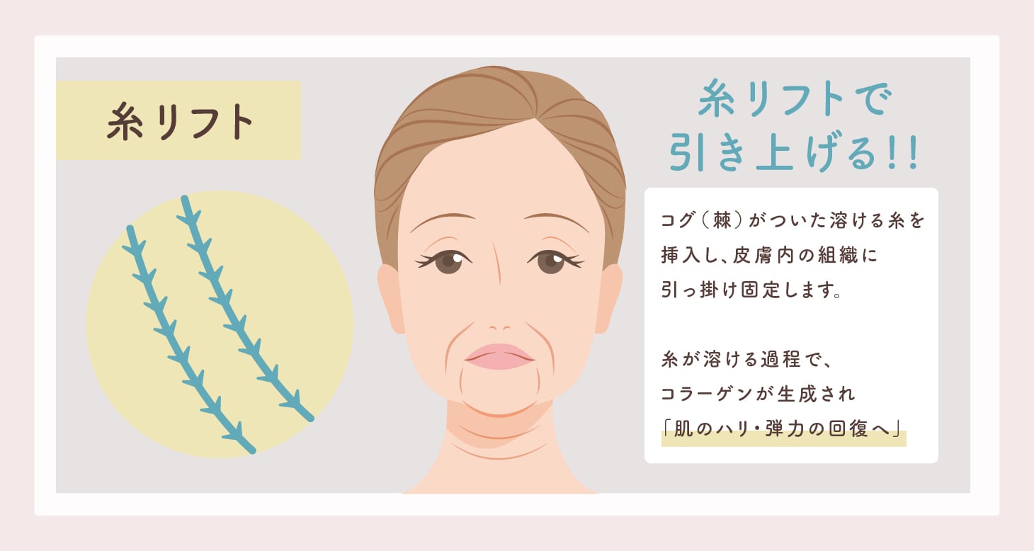 糸リフト