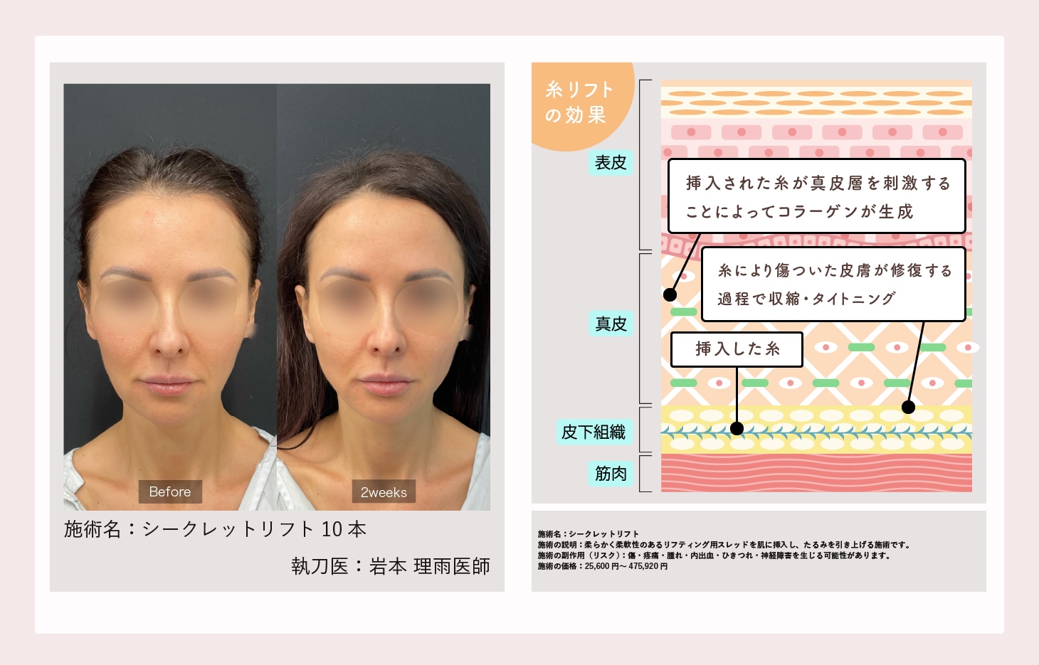 糸リフト