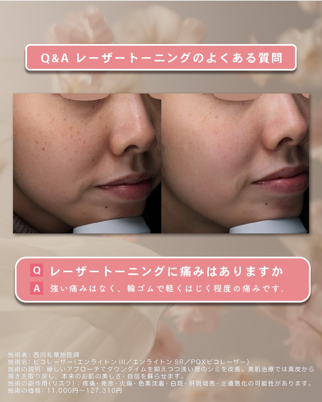 シミ取り初体験の方はコレ！