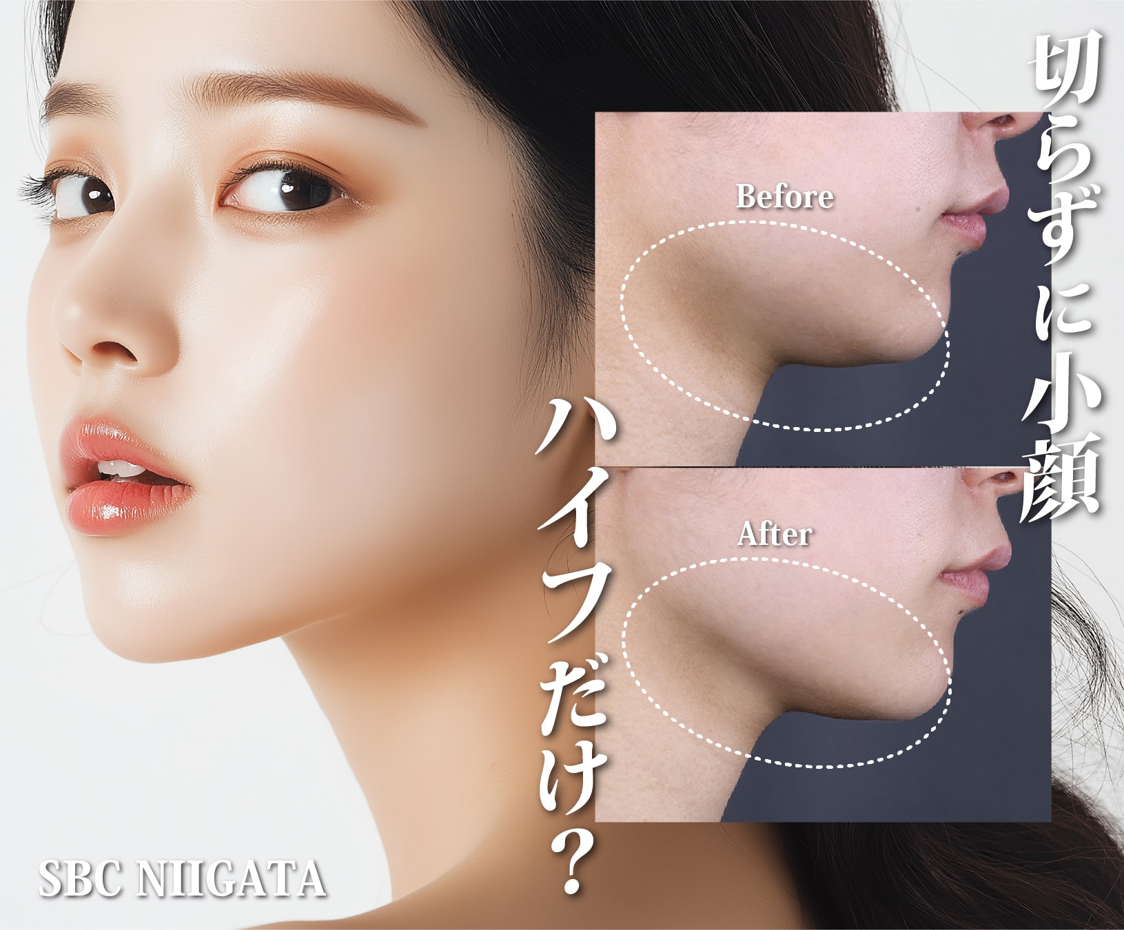 新潟で「切らないたるみ」で輪郭美人💝SBCハイフで若々しいフェイスラインに💖