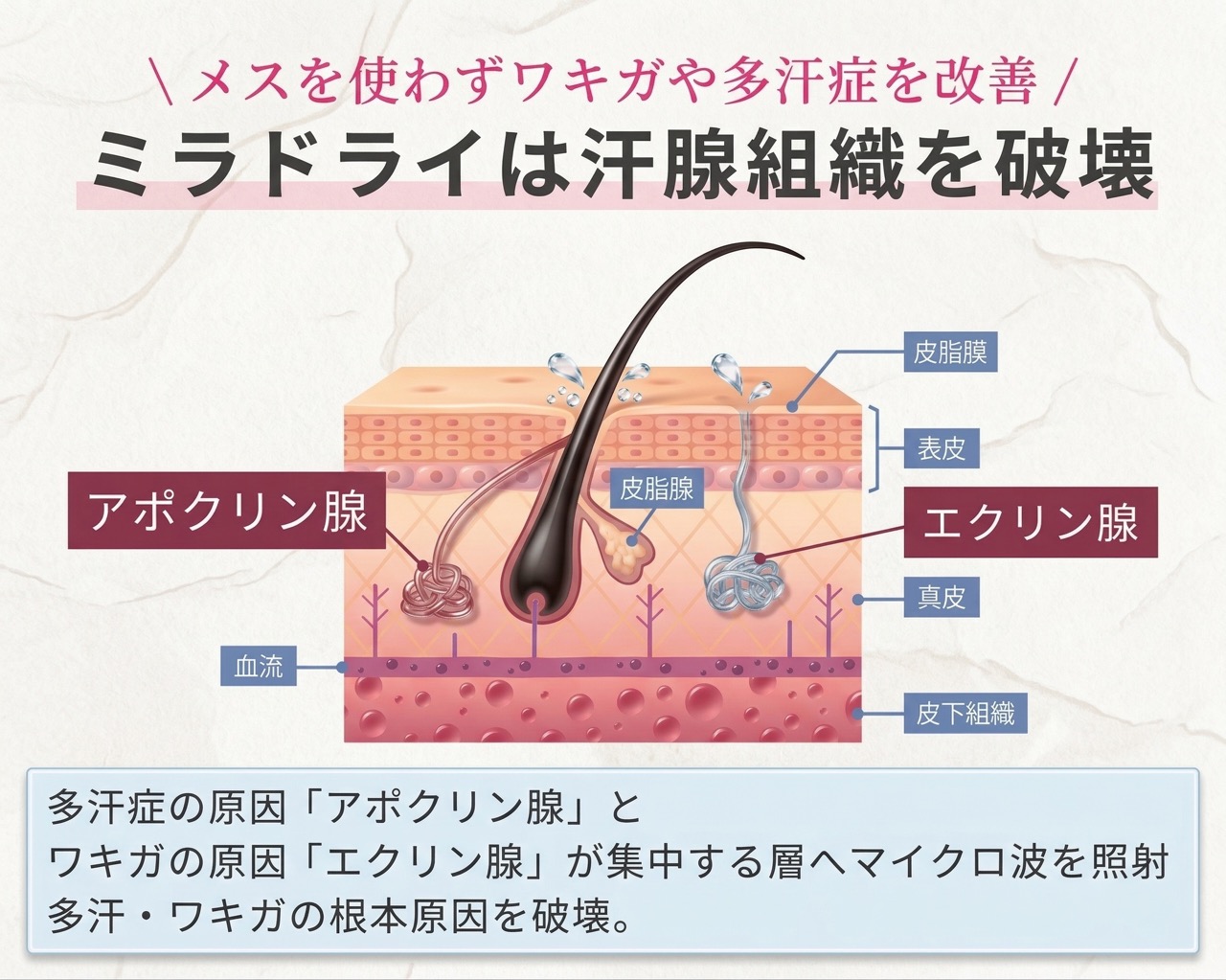 メスを使わずワキガや多汗症を改善！