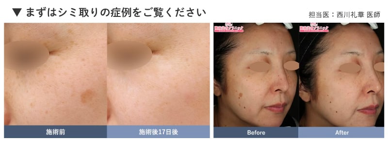 シミをとるとこんなに印象が変わります！