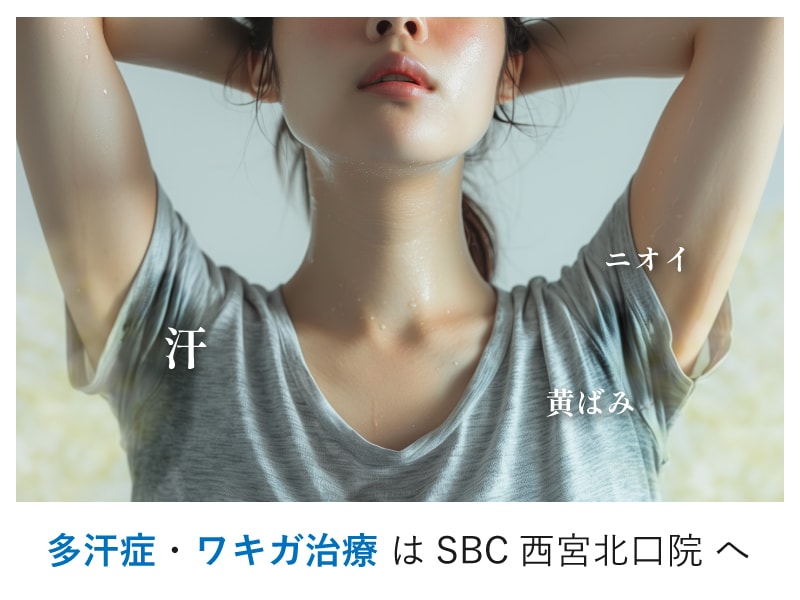 兵庫県西宮市｜多汗症・ワキガ治療はSBC西宮北口院へ