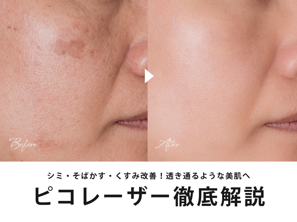 西宮市で「シミ取り」するならSBC西宮北口院の「ピコレーザー」！安い料金で高い効果を！シミ・毛穴・ニキビ跡・くすみ改善が気になる方は必読です！