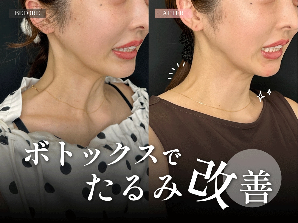 【関西で話題】ボトックスリフトでたるみ改善！神戸西宮市で若返り施術ならSBC西宮北口院がおすすめ