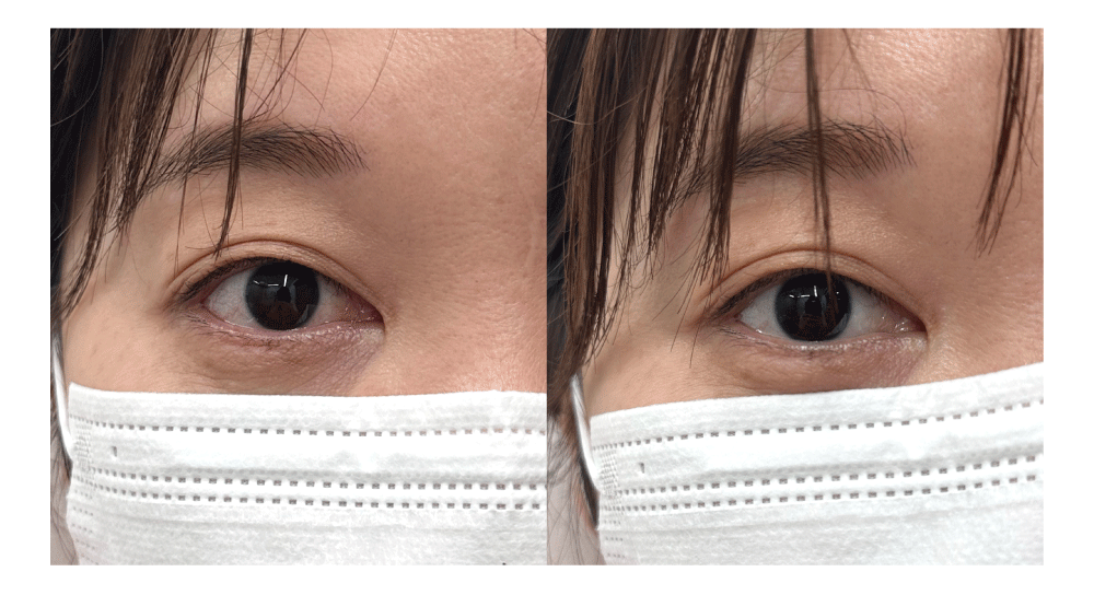<b>目の充血改善</b>（ 左がBEFORE / 右がAFTER ）