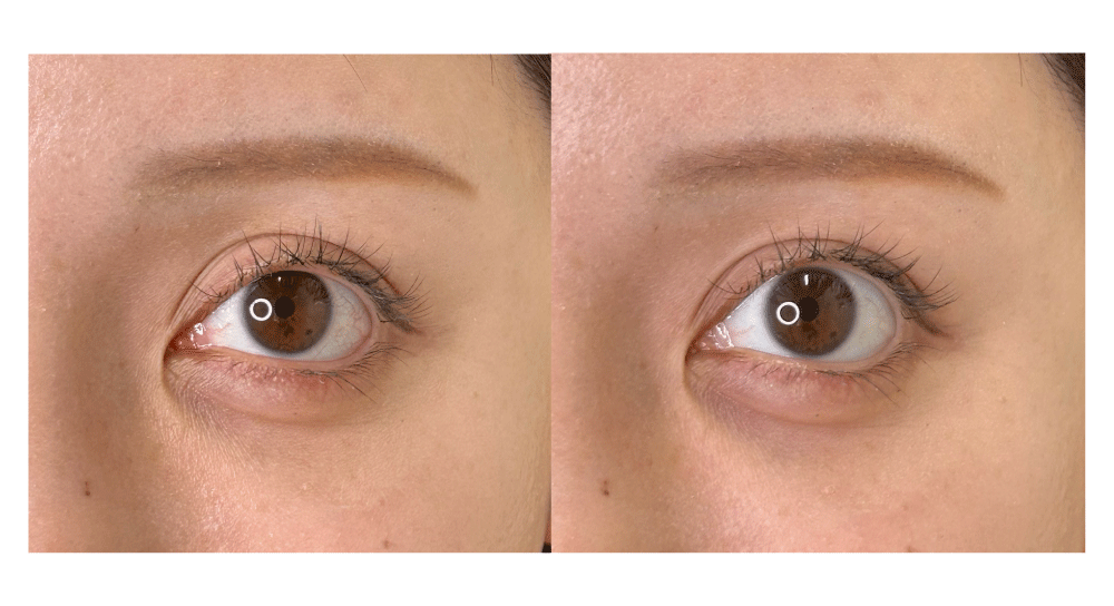 <b>眼瞼下垂の解消</b>（ 左がBEFORE / 右がAFTER ）