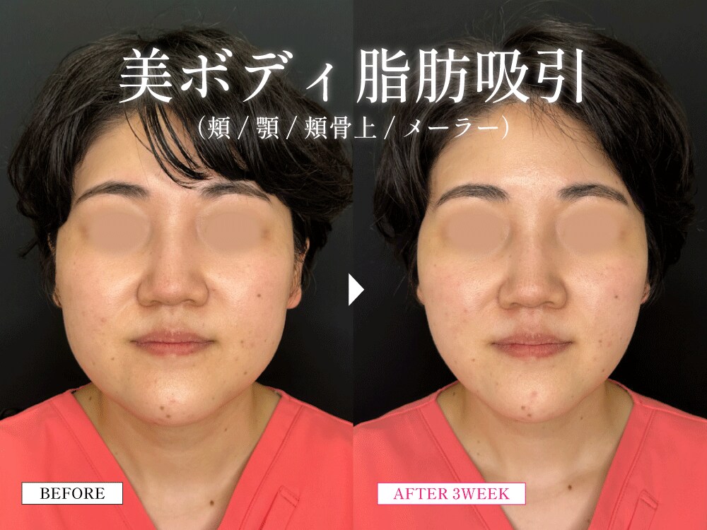 【神戸】西北で働くナースが山口院長に顔の脂肪吸引を依頼！「美ボディ脂肪吸引」で小顔＆フェイスライン改善｜SBC西宮北口院
