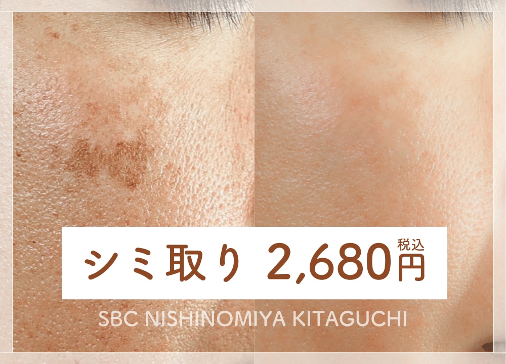 西宮市で安い”シミ取り治療”（1回 2,680円）はSBC西宮北口院へ｜料金・効果・症例を徹底解説